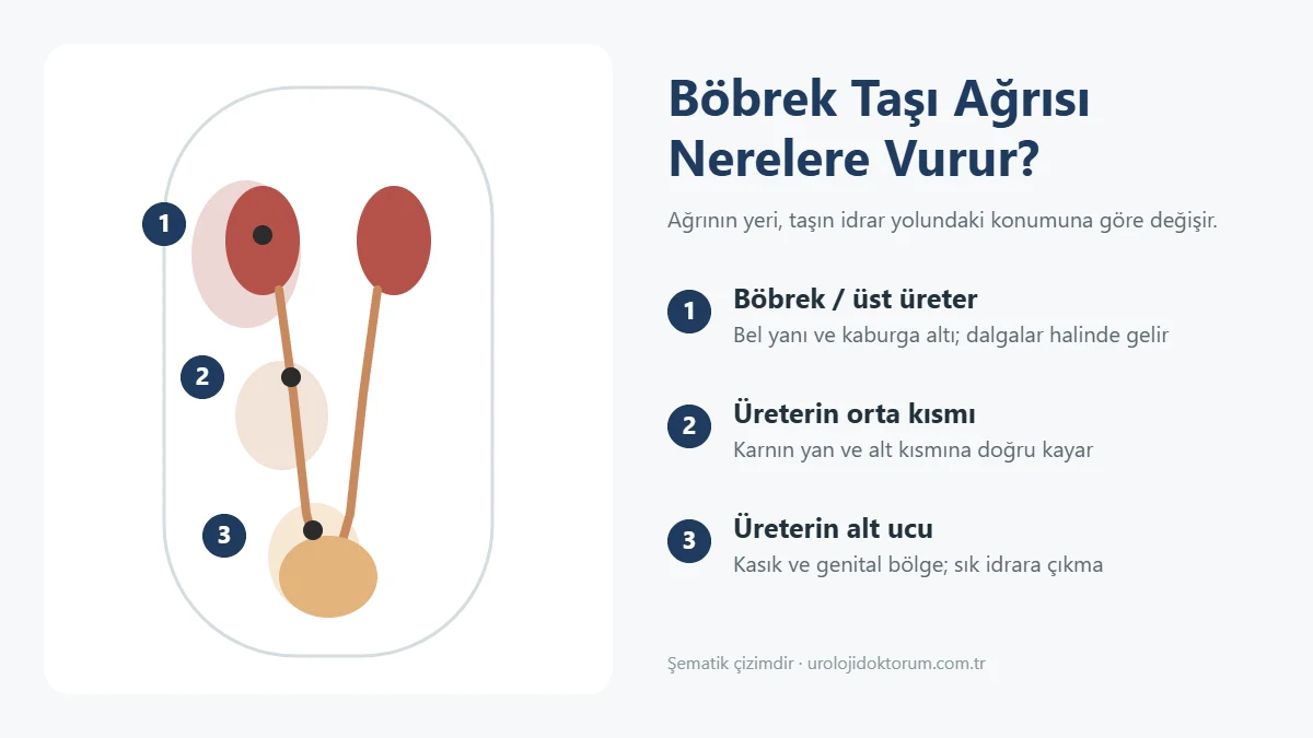 Böbrek taşının konumuna göre ağrının yayıldığı bölgeler